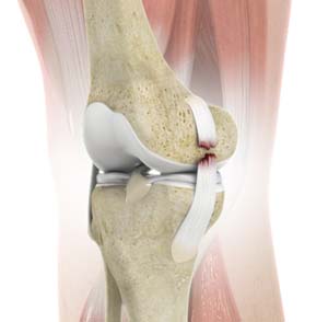 MCL Reconstruction